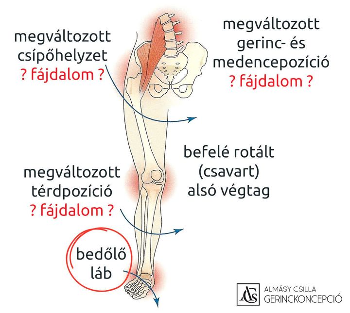 BEDŐLŐ (PRONÁLT) LÁB Amikor a talp teljesen lesimul a talajra, általában rámondják, hogy lúdtalp.…