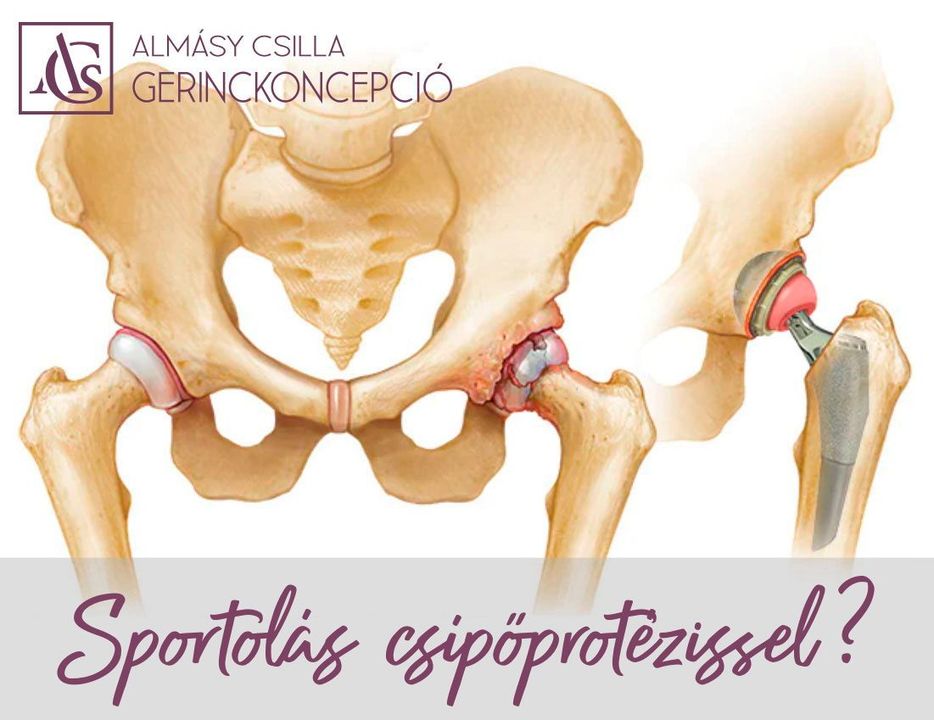 SPORTOLÁS CSÍPŐPROTÉZISSEL? Naná! Ma már olyan műtéti technikával zajlik a csípőízület protetizálása, hogy szinte…